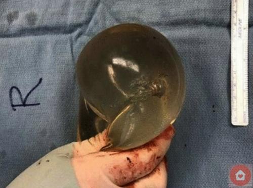 Силиконовый имплант буквально спас девушке жизнь, приняв на себя пулю, летевшую ей прямо в сердце. 01