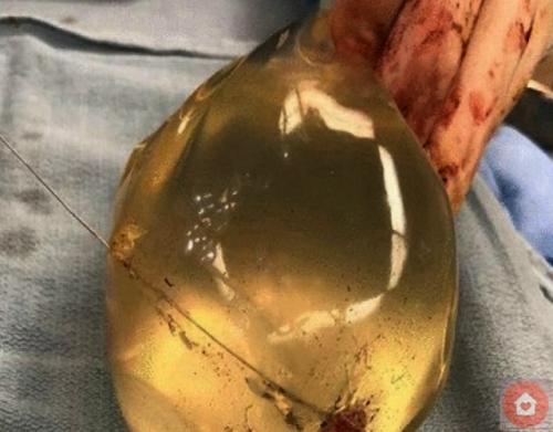 Силиконовый имплант буквально спас девушке жизнь, приняв на себя пулю, летевшую ей прямо в сердце.