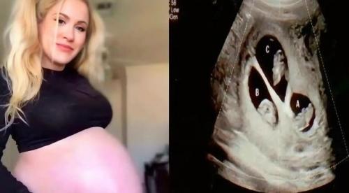 Врачи сделали узи - и были в шоке.  